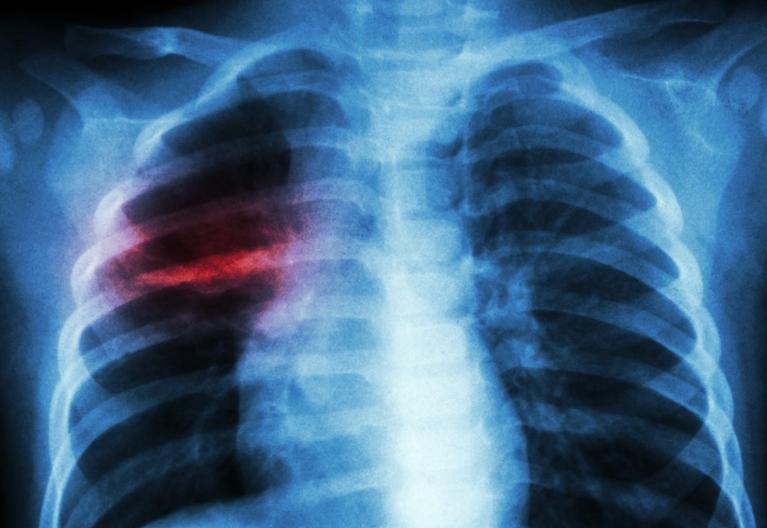 小儿肺炎严重的后果,严重的小儿肺炎怎么治疗