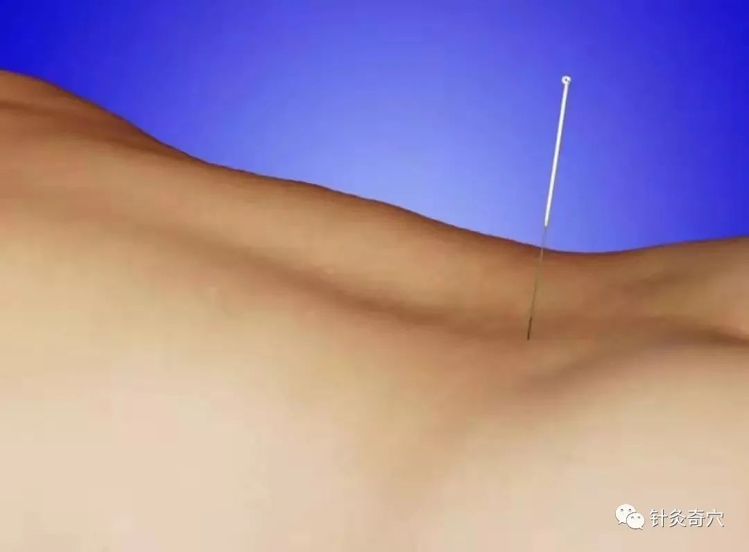 史上最全中医针灸视频教程全集,针灸治疗真实图片大全