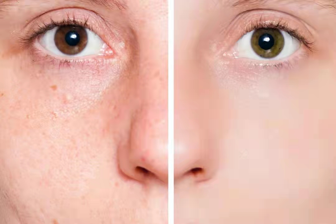 血虚、面色暗,血瘀还有斑,2味中药,活血消瘀,恢复面色红润