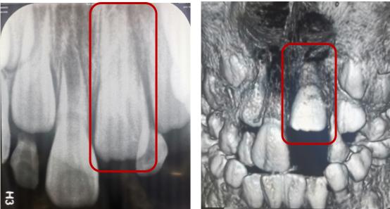 牙齿受外伤吃什么对牙好,牙齿受损伤引起牙痛怎么办