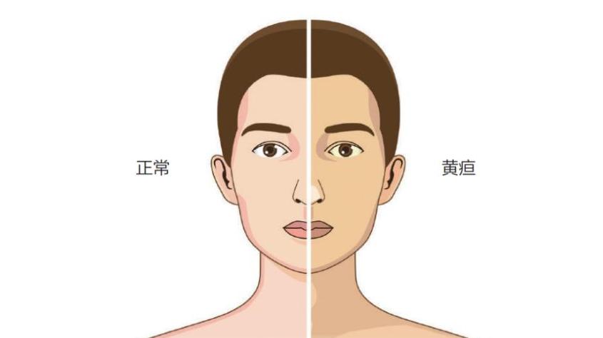 有红点很可能是肝病恶化了,出现这些红点可能是肝硬化