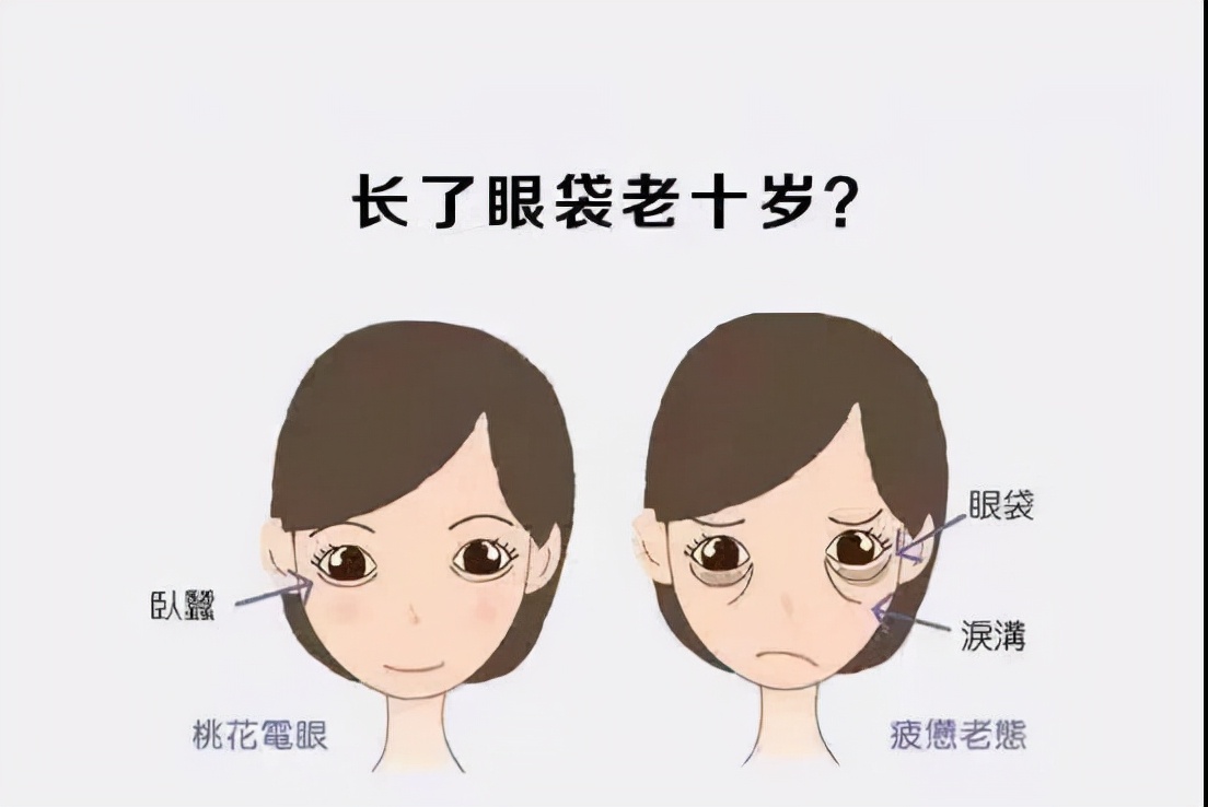 一分钟教你鉴别泪沟卧蚕和眼袋,卧蚕眼袋泪沟是手术好还是填充好