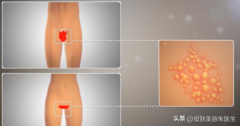 怎么区分尖锐性湿疣和生殖器疱疹,分辨尖锐性湿疣