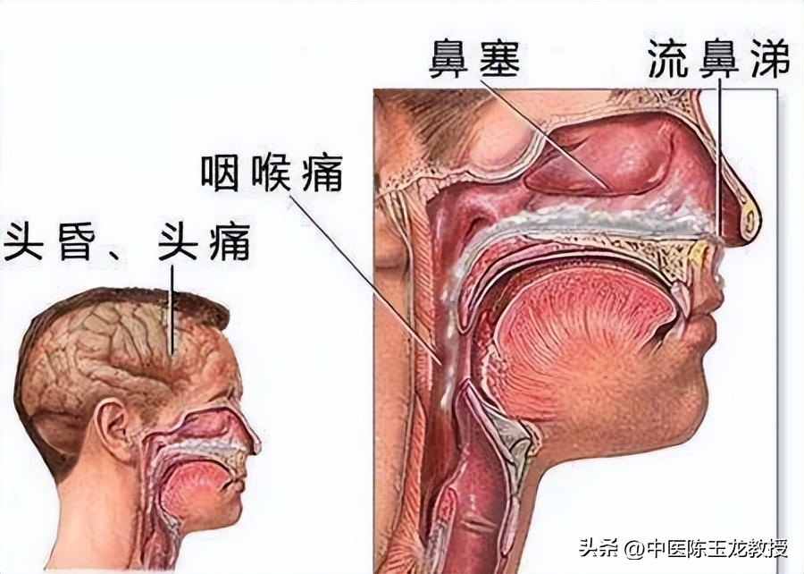 头微痛鼻塞吃什么药,急性鼻窦炎鼻塞怎么缓解