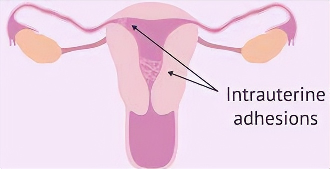 子宫内膜-成功妊娠的秘密*器武**