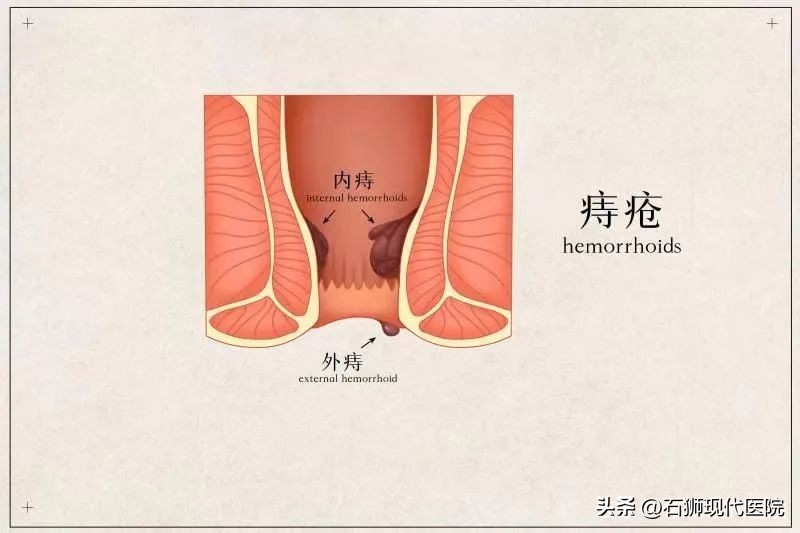 得了痔疮不治疗会自然痊愈吗,外痔疮不治疗有什么后果