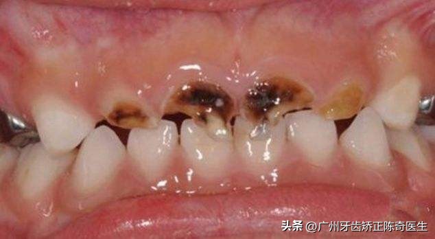 小孩子大牙蛀牙严重怎么办,为啥有的小孩满嘴蛀牙都掉完了