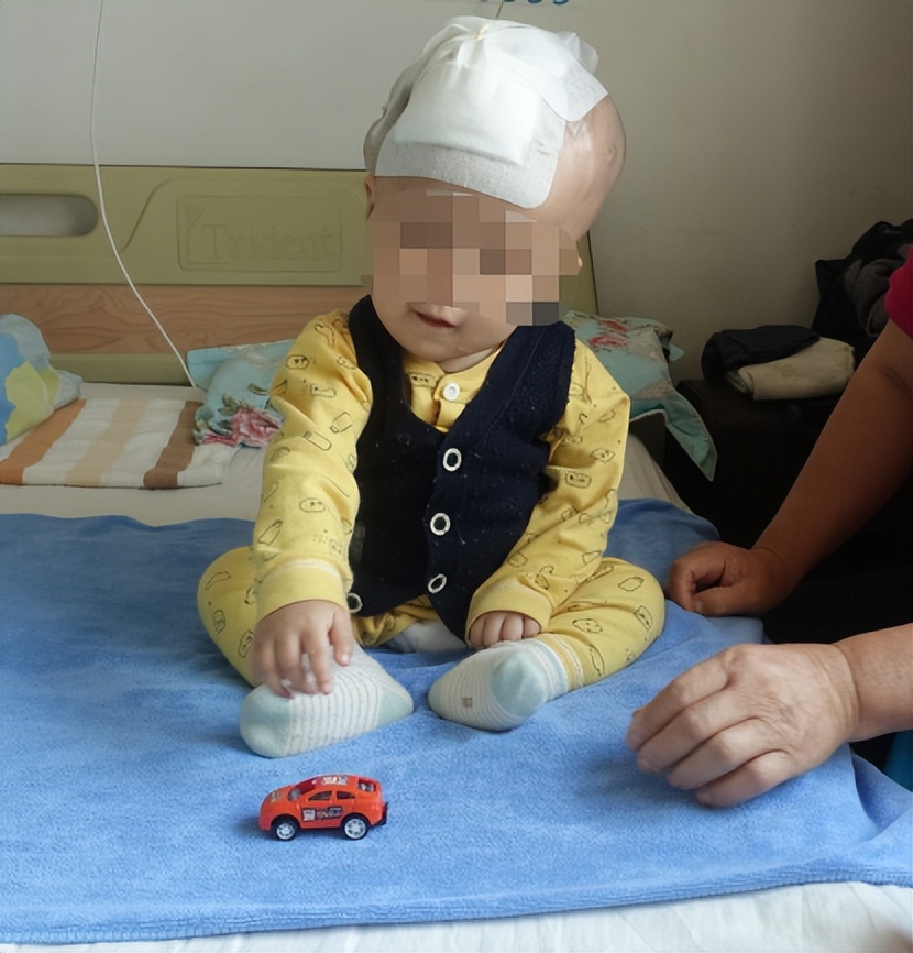 蛛网膜囊肿合并脑积水腹腔分流术,治疗蛛网膜囊肿引起脑积水严重吗