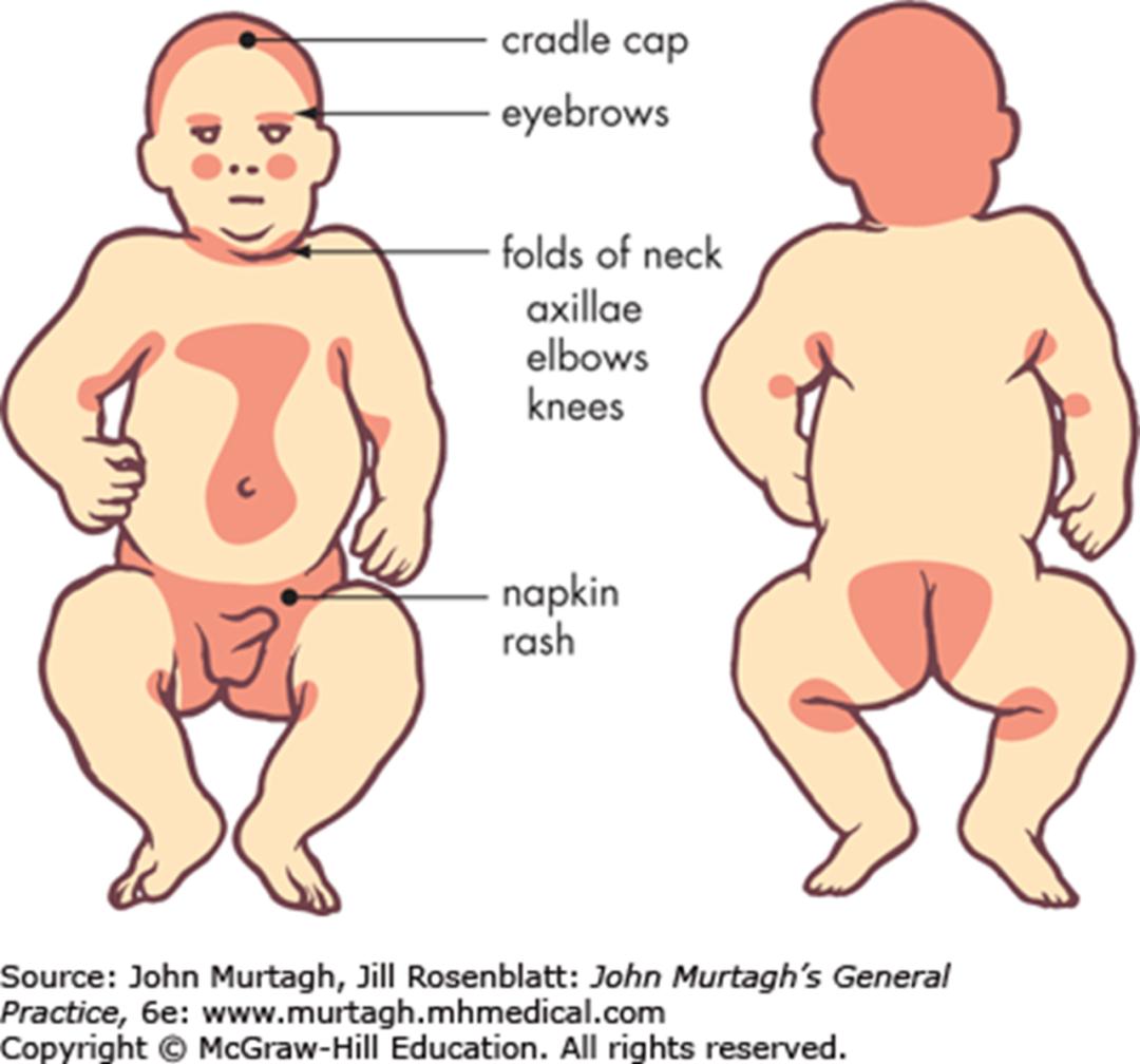 湿疹症状有哪些？湿疹原因、预防一次看，4招有效止痒