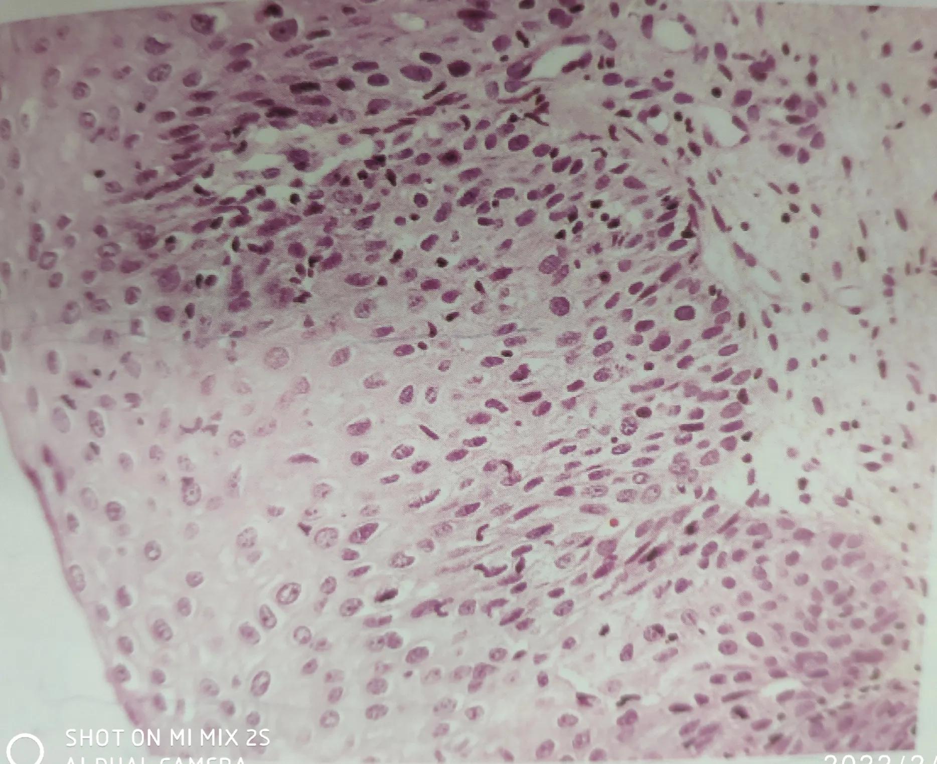 活检结果cin3有可能是宫颈癌吗,宫颈病理报告炎症会显示异常吗