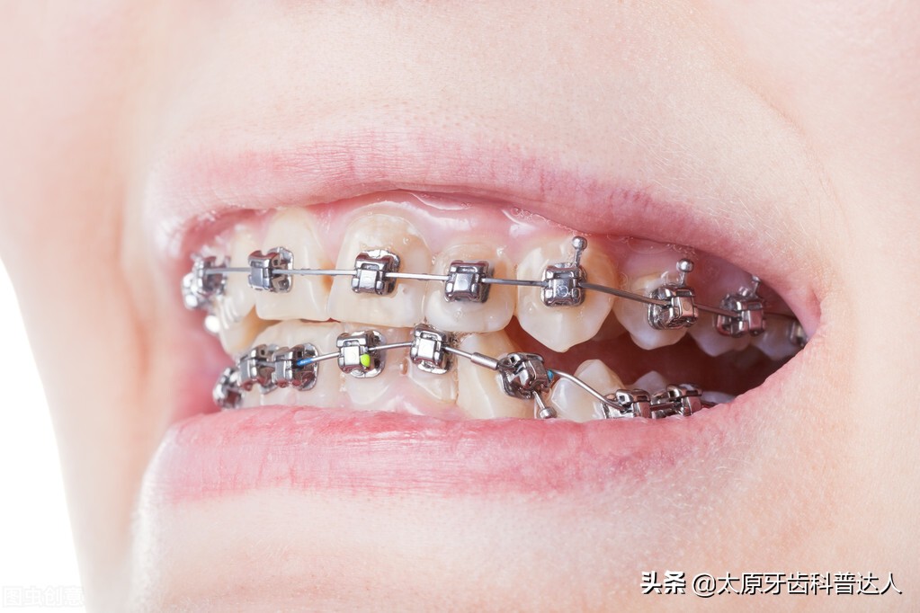 戴矫正牙套可以做磁共振吗,孩子矫正牙齿需戴多久牙套