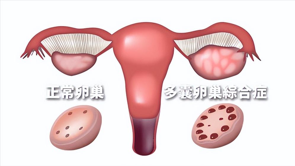 卵巢巧克力囊肿合并多囊卵巢,什么是巧克力卵巢囊肿怎么治疗