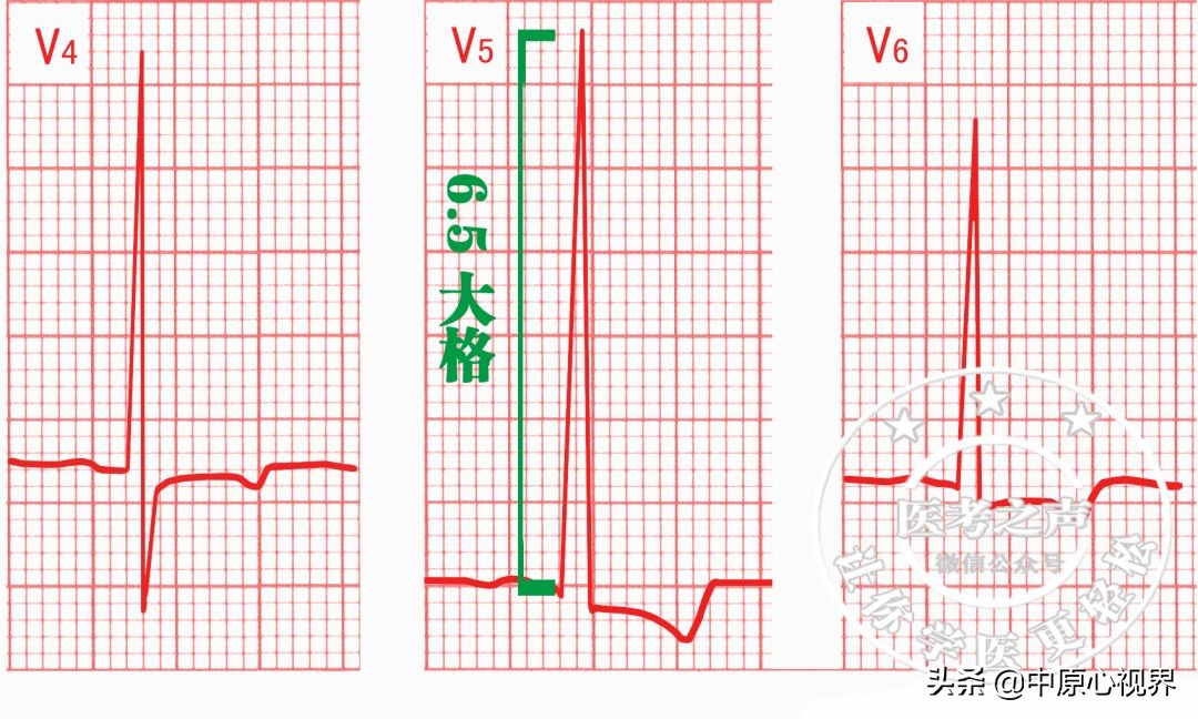护考几种常见的心电图,常见的心电图图形分析