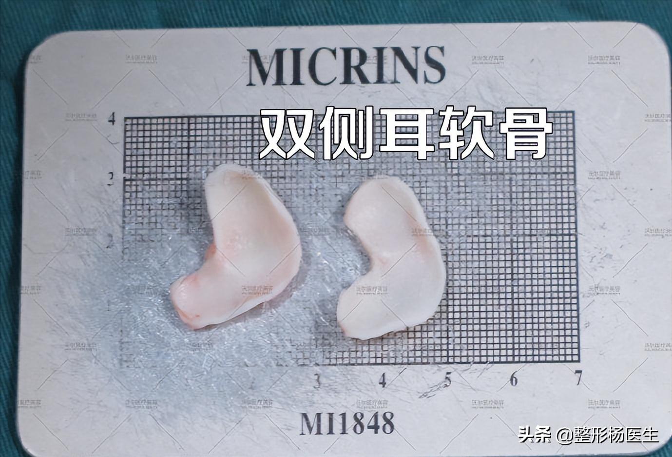 注射隆鼻和假体隆鼻哪个好,隆鼻和综合隆鼻整形有什么区别