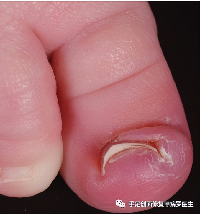 宝宝脚趾甲有脓了怎么处理,给宝宝剪指甲流脓怎么办