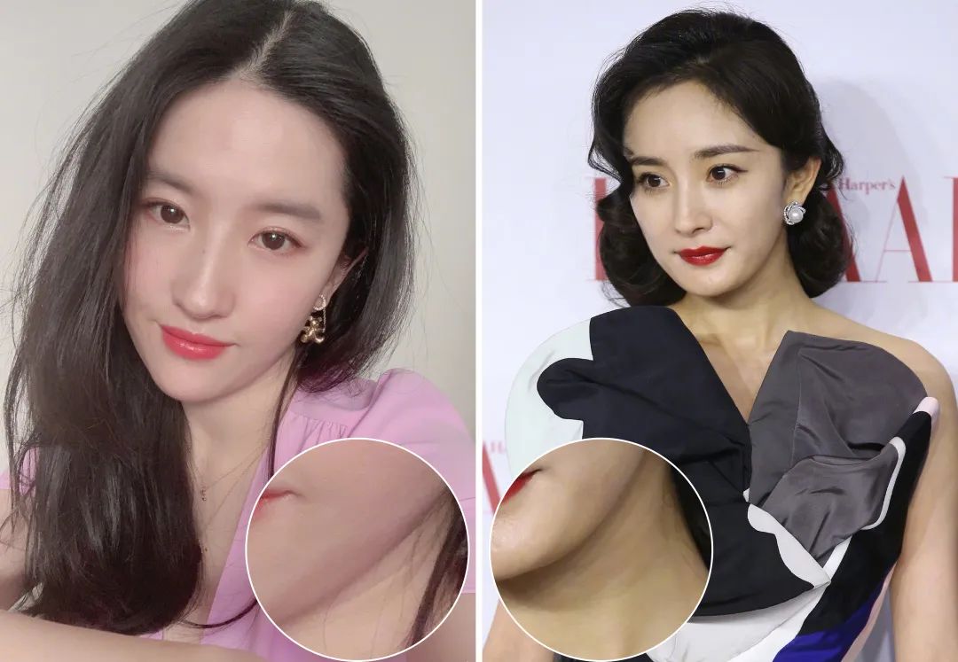 1条颈纹=显老10岁，可怕的颈纹还有救吗？