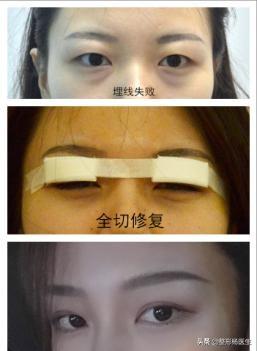 肿眼泡适合做埋线双眼皮吗,贴双眼皮贴还是肿眼泡可以埋线吗