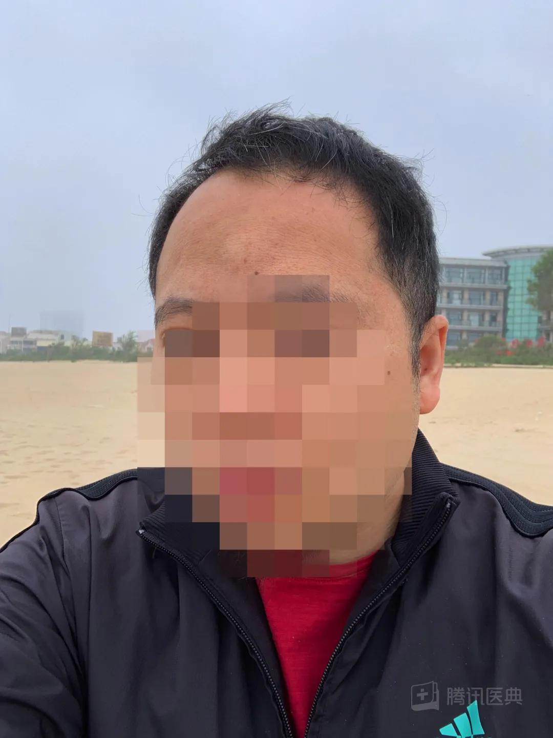 开颅手术后被掀开的头皮多久恢复,开颅手术掀开头皮头皮怎么恢复的