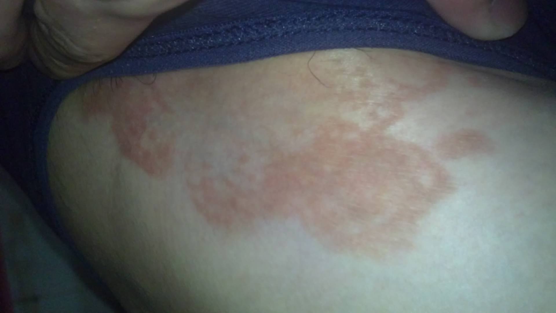 怎样知道股癣已根治,股癣和体癣怎么治疗最好