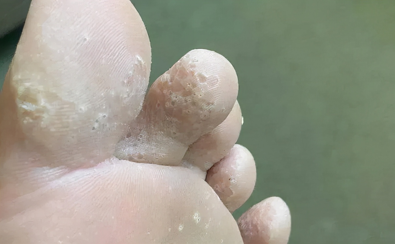 为什么长筒靴脚踝处容易摩擦,长期穿靴子脚会怎么样