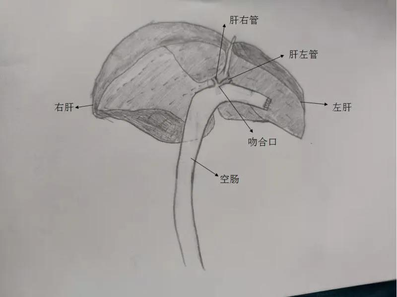 肿瘤患者尿液呈茶色,小便呈茶色尿常规正常