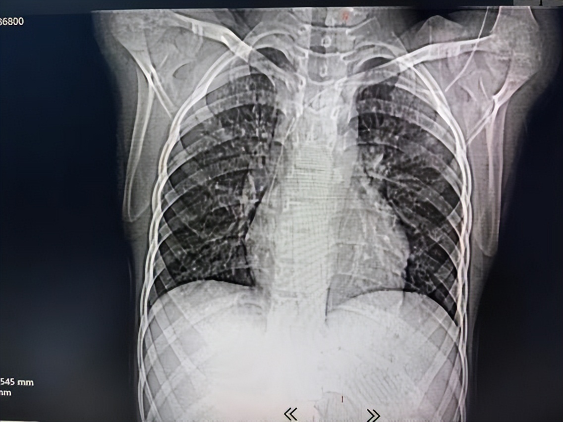 picc拔管遇导管断裂如何处理,picc导管断裂的影像表现