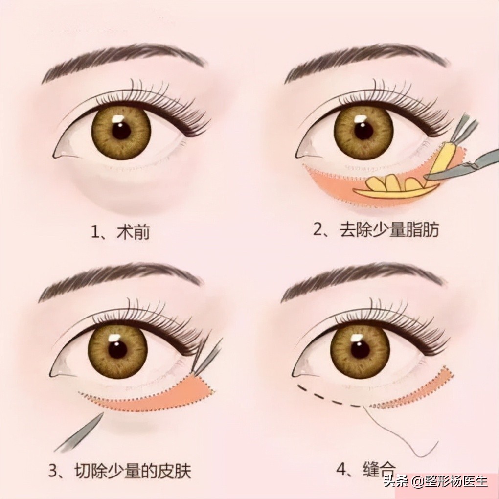 眼袋手术后真的显年轻吗,割眼袋能年轻几岁