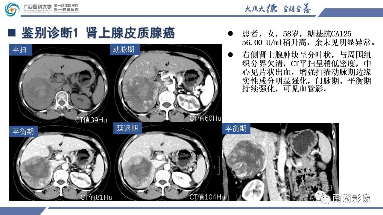 肾上腺海绵状血管瘤,肾上腺血管瘤是良性还是恶性