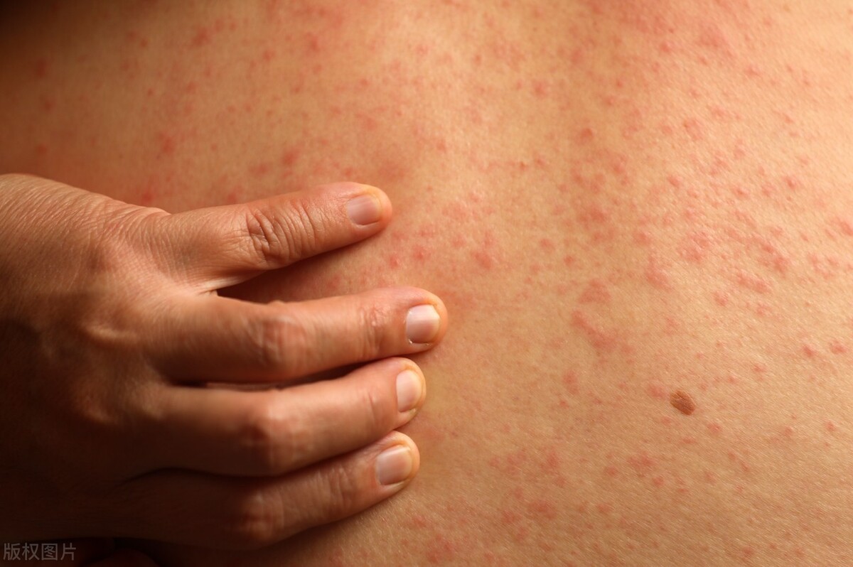 为什么不能从根源上解决过敏,最可怕的过敏症