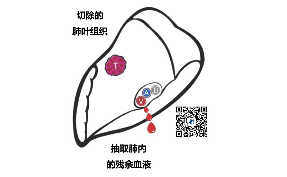 术后一定会有残存的肿瘤细胞么,手术能彻底清除淋巴里癌细胞吗
