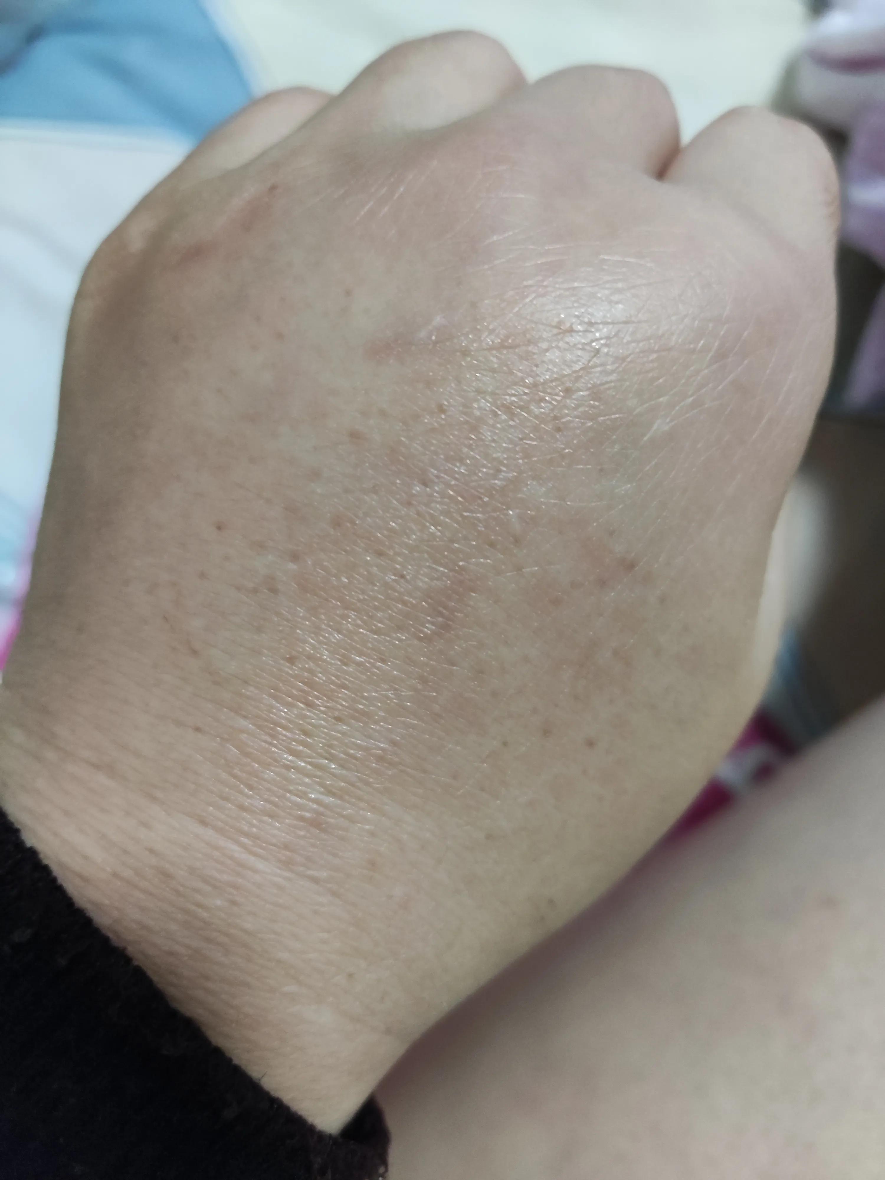 被小区花园里的蜂蛰了,院子里的蜜蜂被蛰了