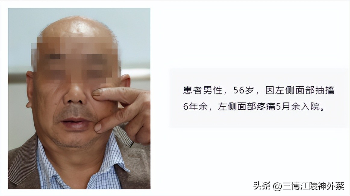 双侧面肌痉挛真实案例,面肌痉挛会发展成三叉神经痛吗