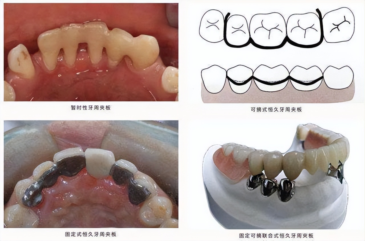 老年人牙齿松动会自动掉吗,老年人洗牙更容易牙齿松动吗
