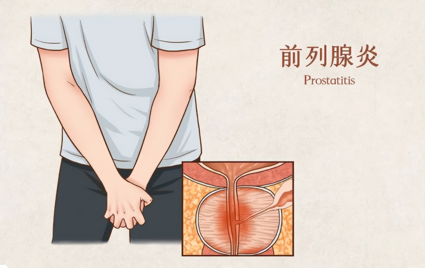 张景明慢性前列腺炎中药治疗,慢性前列腺炎的中医治疗方法介绍