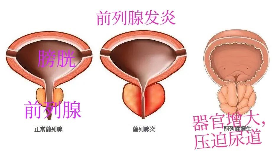 急性前列腺炎该怎么治疗好,急性前列腺炎怎么治疗比较好