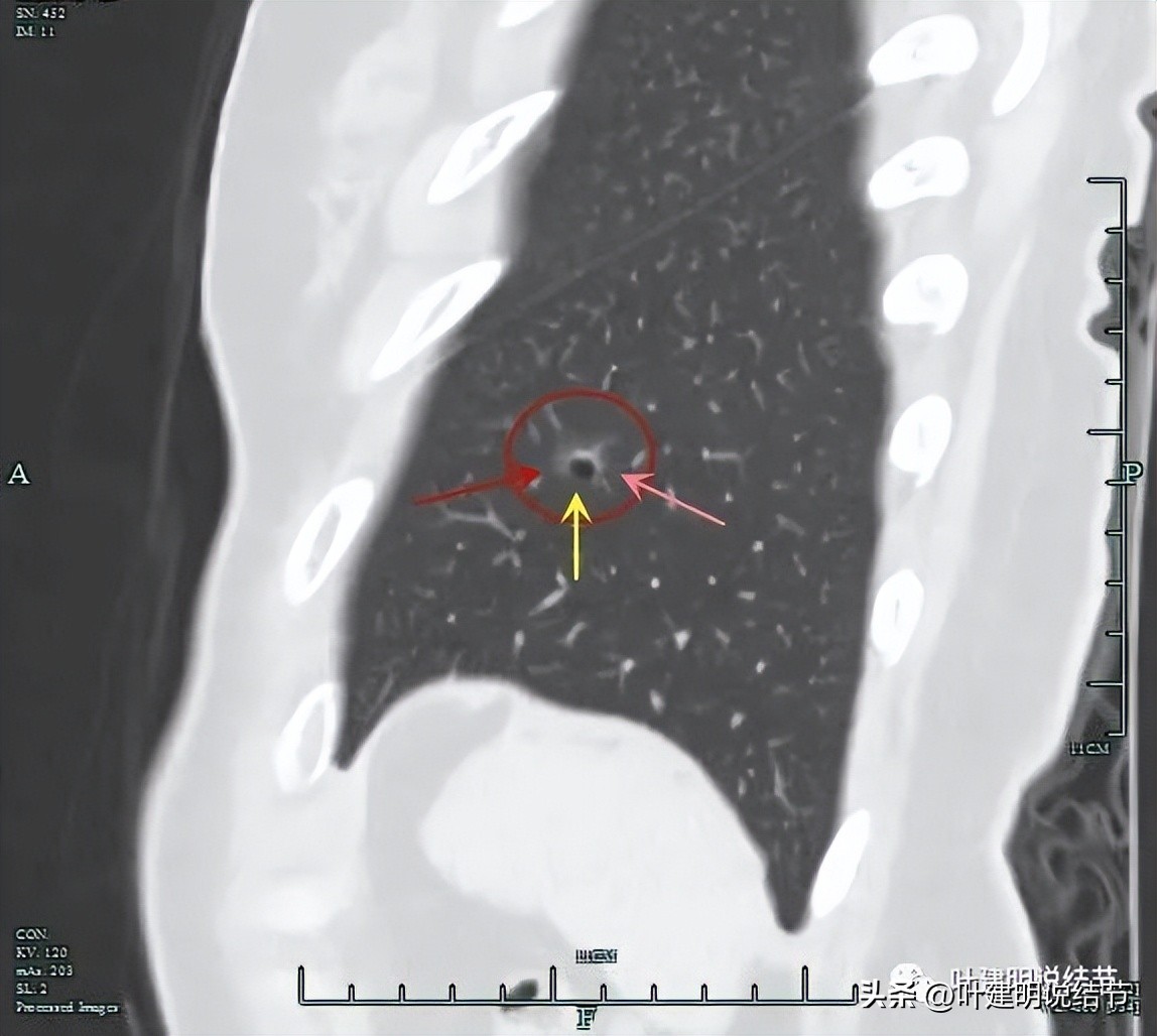 辽宁省肺结节手术哪家医院好,辽宁肺结节手术医院
