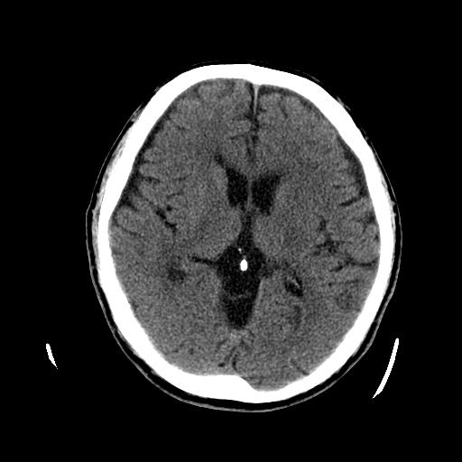 阿尔茨海默症后期摔倒,阿尔茨海默症骨折