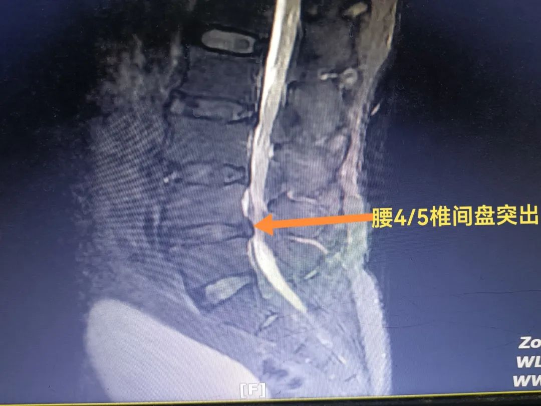 临邑县人民医院治疗腰腿疼,泰安宁阳郭医生治腰腿疼