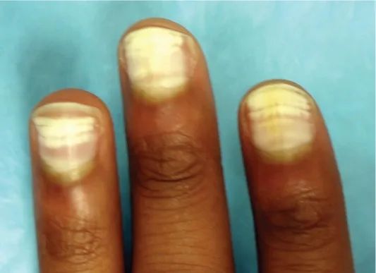 指甲有竖纹有月牙怎么回事,指甲月牙不是很白怎么回事