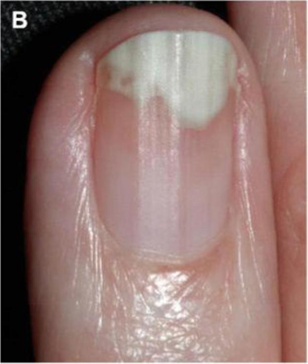 指甲有竖纹有月牙怎么回事,指甲月牙不是很白怎么回事