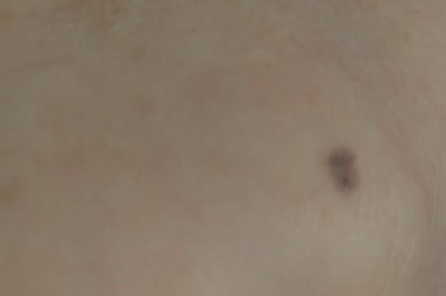 小孩把铅笔芯不小心捅进手皮里了,8岁孩子被铅笔戳到手怎么办