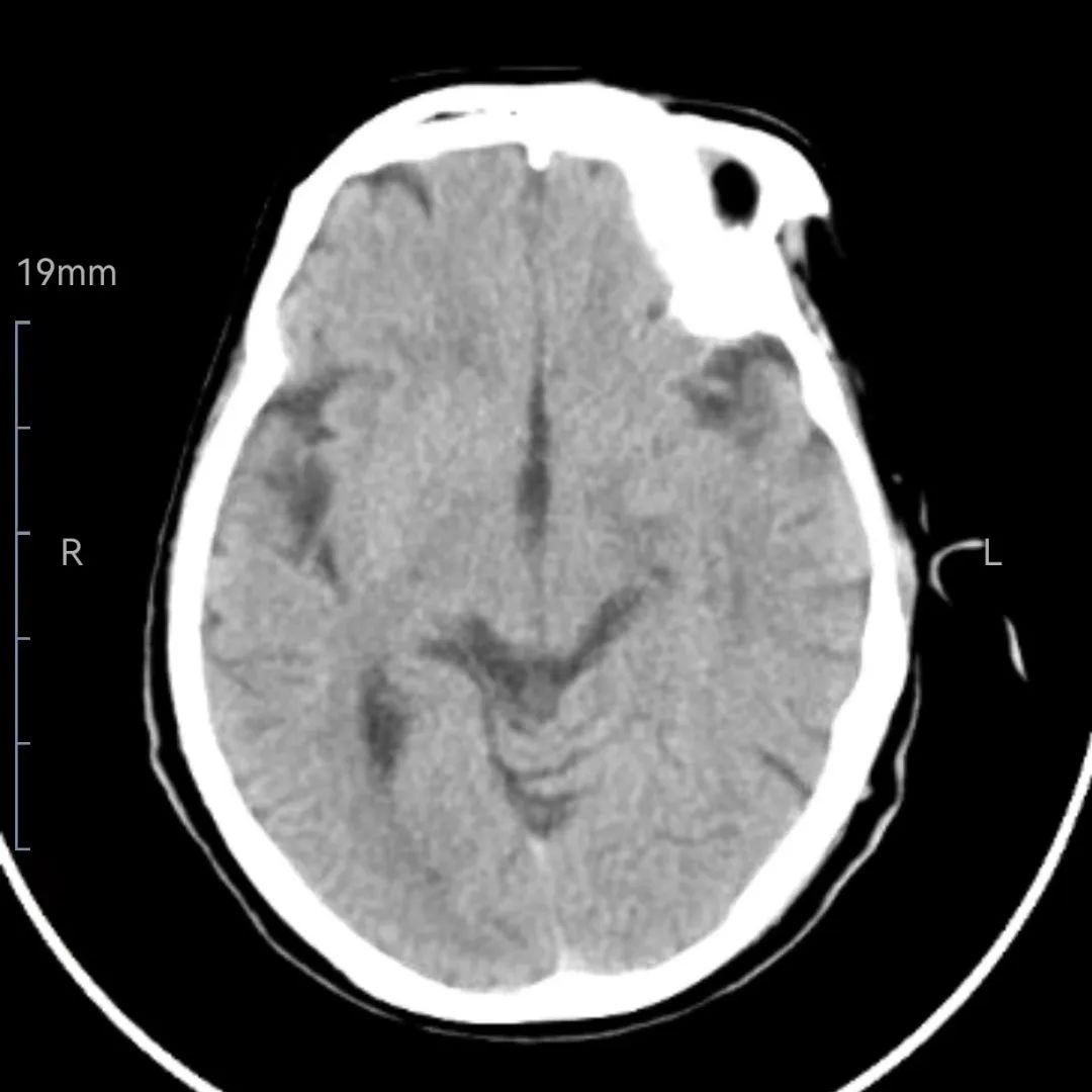 西安脑梗取栓康复医院,西安市第三医院脑卒中急救
