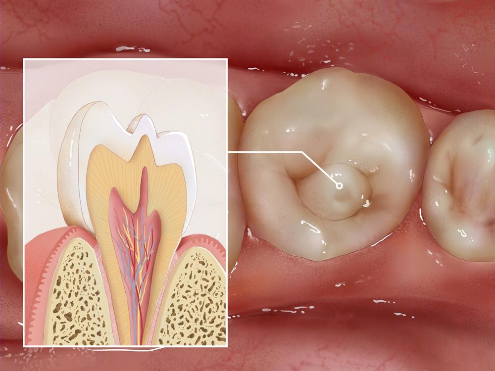 牙齿长小犄角,牙齿侧面长犄角