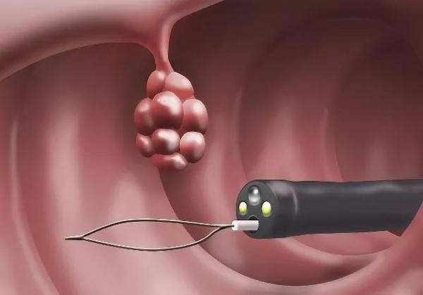 肠镜检查有哪些注意事项,肠镜检查准备什么才是最佳的