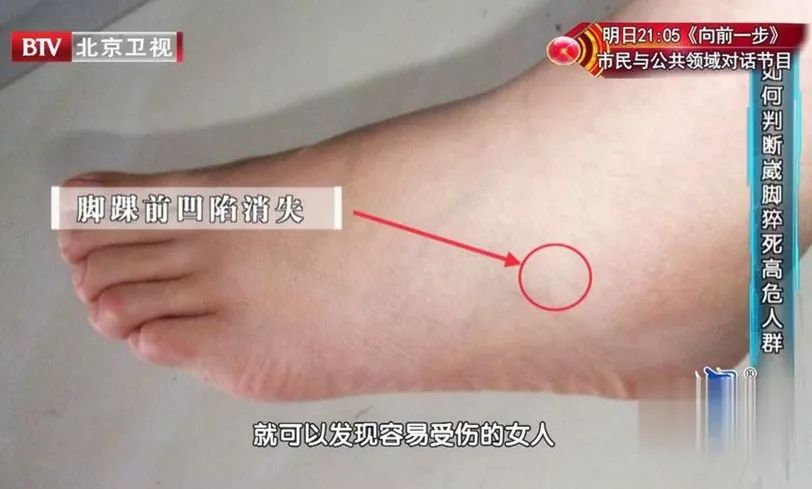 旧拖鞋千万别丢试试这个办法,预防下肢静脉血栓袜子