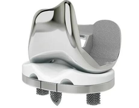 案例l利用西门子NX将非骨水泥全膝关节置换术,TKA建模和准备时间减少50%