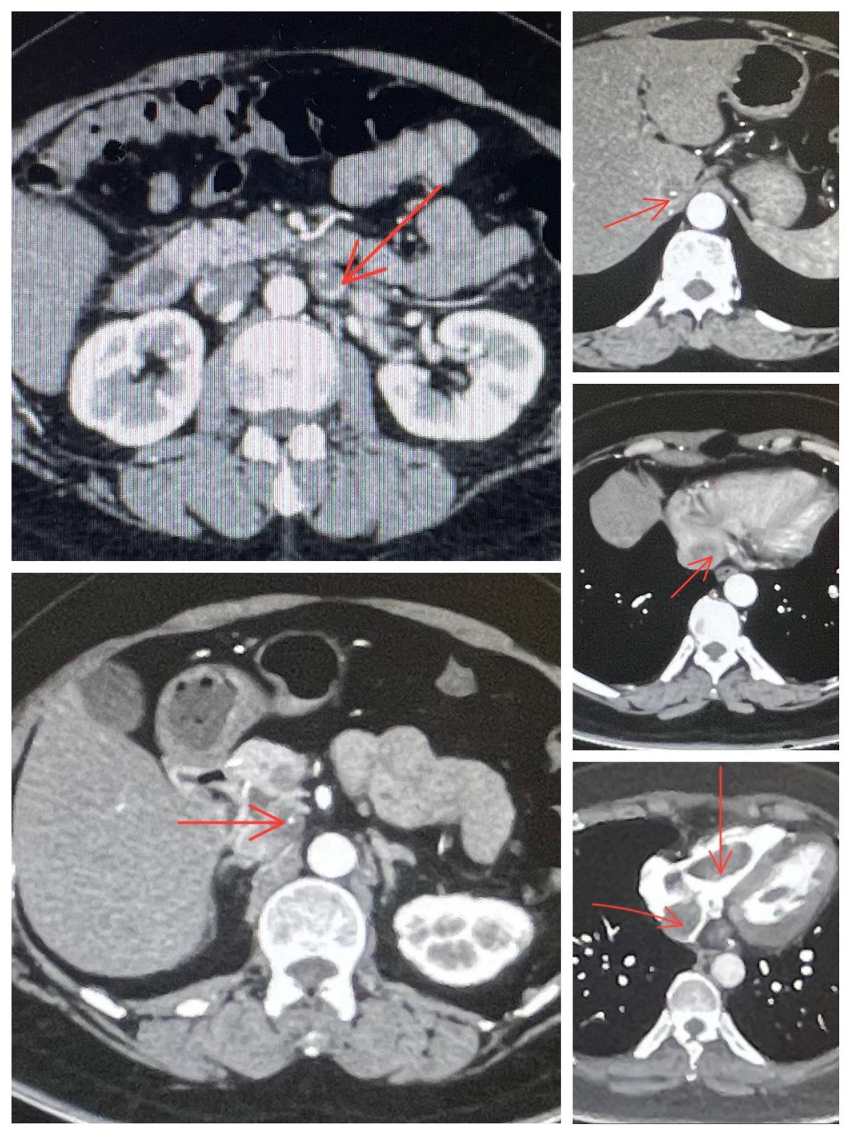 兰大二院心脏科,兰大二院心脏外科