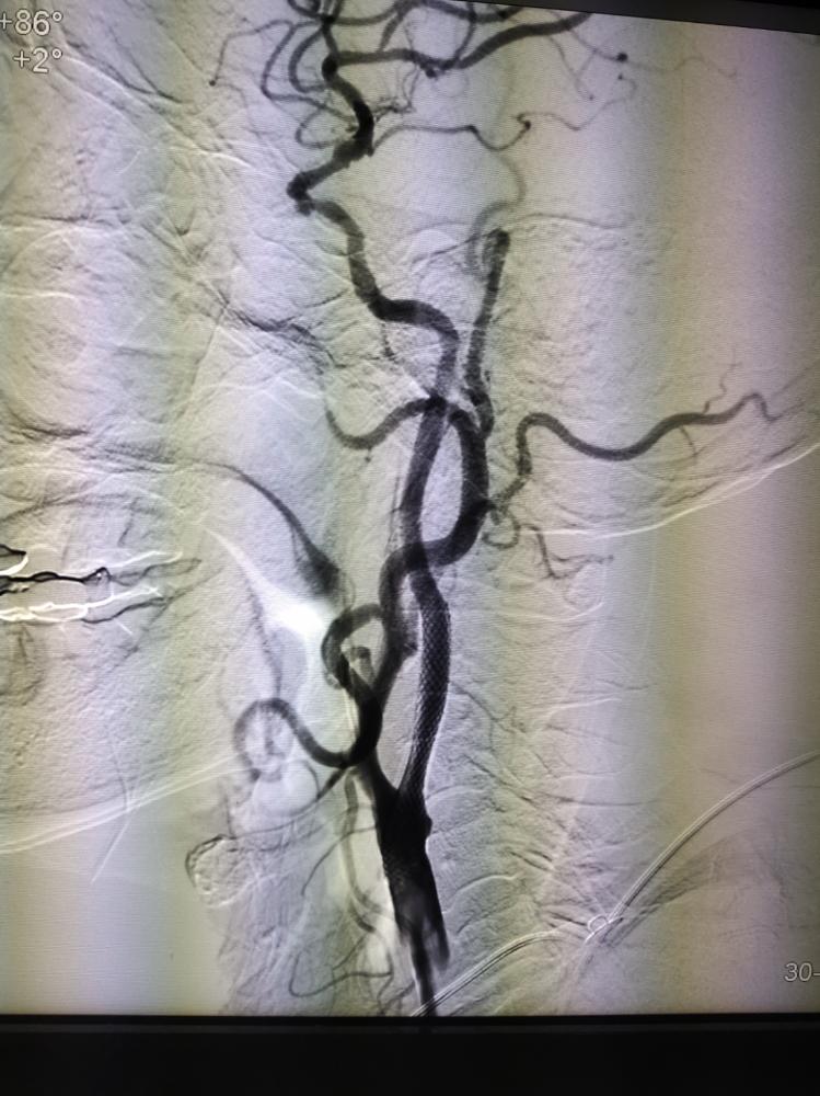 脑血管病介入治疗的介绍,治疗心脑血管病的先进技术
