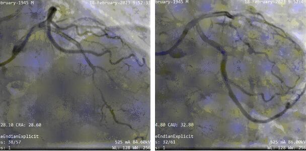 3DF打印助力温州医科大温州医科大学附属第一医院周浩团队完成一例复杂高危的冠脉CTO手术
