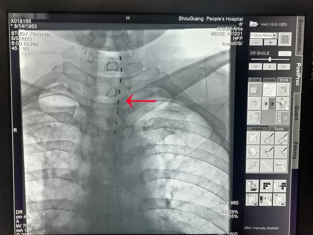 脊髓神经调控技术治疗瘫痪,最新技术治疗中枢神经